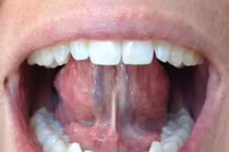 6 bài tập chữa ngủ ngáy hiệu quả nhất