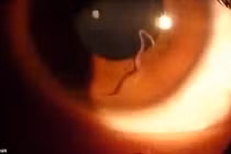 Video khủng khiếp ký sinh trùng ngọ nguậy trong mắt