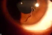 Video khủng khiếp ký sinh trùng ngọ nguậy trong mắt