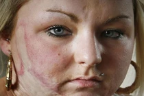 Kinh hãi bỏng toàn thân vì đốt sợi chỉ thừa trên váy