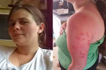 Cô gái “ma cà rồng” cứ ra nắng là lở da, chảy nước