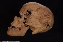 Cận cảnh ca ung thư vú cổ đại vừa được phát hiện