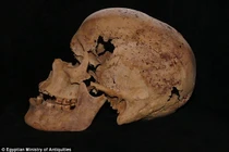 Cận cảnh ca ung thư vú cổ đại vừa được phát hiện