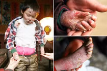 Xót xa cậu bé có làn da mỏng như cánh bướm