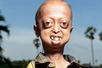 Rùng mình những căn bệnh ma quái gây sống dở chết dở