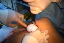 Cận cảnh quá trình phẫu thuật độn mông đau đớn