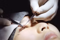 Những hình ảnh phẫu thuật cắt mí đầy đau đớn