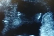 Kinh ngạc em bé trong bụng mẹ say sưa vỗ tay