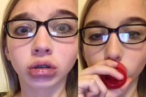 Trào lưu hít chai để môi sưng vù như Kylie Jender