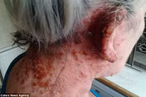 Hãi hùng những ca dị ứng thuốc nhuộm tóc 