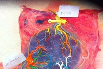 Cận cảnh nhau thai của bà mẹ sinh 3 gây xúc động mạnh