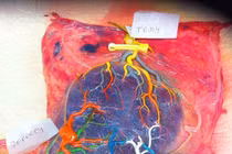 Cận cảnh nhau thai của bà mẹ sinh 3 gây xúc động mạnh