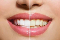Thủ phạm khiến răng vàng khè mà bạn không ngờ đến