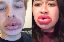 Dựng tóc gáy với những hình ảnh kinh dị về bơm môi