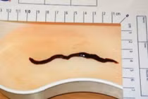 Kinh hãi tử vong vì bị giun “khổng lồ” ăn thận