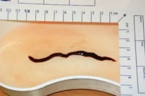 Kinh hãi tử vong vì bị giun “khổng lồ” ăn thận