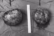 Đặt túi ngực dởm, người phụ nữ đau đớn vì ngực vỡ, biến dạng