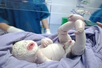 Thương tâm bé sơ sinh mắc bệnh hiếm da toàn thân dày, nứt từng mảng