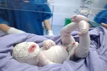 Thương tâm bé sơ sinh mắc bệnh hiếm da toàn thân dày, nứt từng mảng