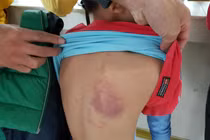 Cô giáo bị tạm đình chỉ do bị tố đánh học sinh thâm tím