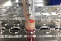 Uống mỗi ngày một cốc trà sữa, bác sĩ hút máu ra thứ này