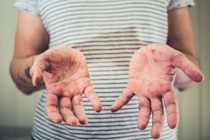 Người lớn có thể mắc bệnh tay chân miệng không?