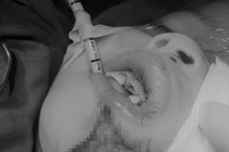 Bé trai 4 tuổi bị chó cắn rách cằm