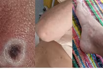 Ca đầu tiên mắc đậu mùa khỉ: ‘Tôi phát hiện bệnh khi đi khám vùng kín’