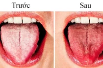 Tại sao lưỡi của bạn chuyển sang màu trắng? 