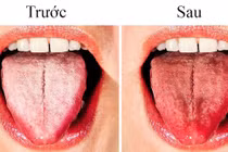Tại sao lưỡi của bạn chuyển sang màu trắng? 