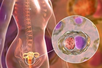 Dấu hiệu bệnh ung thư phổ biến ngửi thấy được