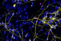 Vắc-xin Zika có thể tiêu diệt tế bào ung thư não