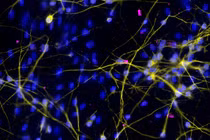 Vắc-xin Zika có thể tiêu diệt tế bào ung thư não