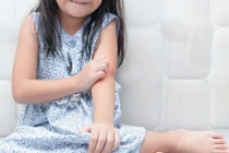 Những bệnh ngoài da thường gặp ở trẻ