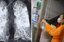 Triệu chứng mắc di chứng phổi sau khi âm tính 