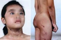 Bé 6 tuổi bị mẹ kế bạo hành như thời trung cổ