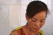 Tạt 2 lít axit trả thù tình đơn phương với cháu 11 tuổi