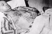 Chạm trán UFO, người đàn ông bị bỏng nặng, 32 năm không mờ vết