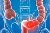 Bốn bệnh dễ bị nhầm lẫn với ung thư đại tràng
