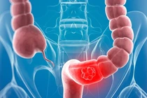 Bốn bệnh dễ bị nhầm lẫn với ung thư đại tràng