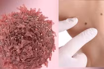 Nốt ruồi mọc ở 3 bộ phận hay “liên quan mật thiết” đến ung thư