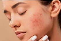 Các yếu tố âm thầm gây ung thư da