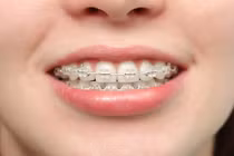 Phương pháp thẩm mỹ răng nào an toàn và được lựa chọn nhiều nhất?