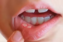 Dấu hiệu của ung thư môi bạn không nên coi thường