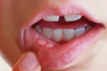 Dấu hiệu của ung thư môi bạn không nên coi thường