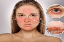 Mẹo chăm sóc da nhạy cảm nhất định phải biết