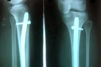 Cẩm nang sống khỏe cho người vừa bị gãy xương