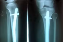 Cẩm nang sống khỏe cho người vừa bị gãy xương