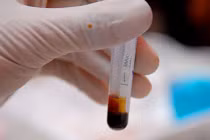 Cách đơn giản giúp chẩn đoán ung thư đầu cổ