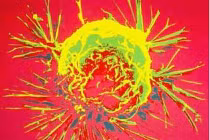 Những tưởng tượng phi lý về căn bệnh ung thư